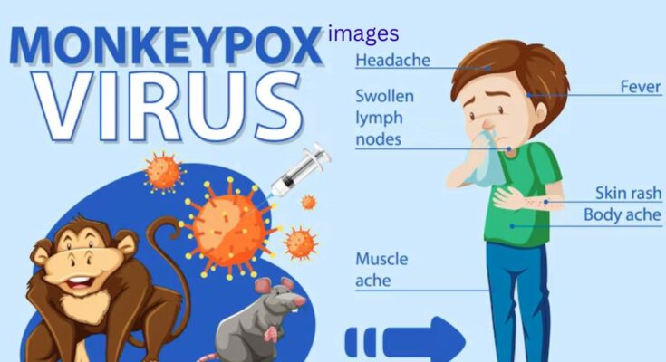 Understanding Monkey Pox With Key Images